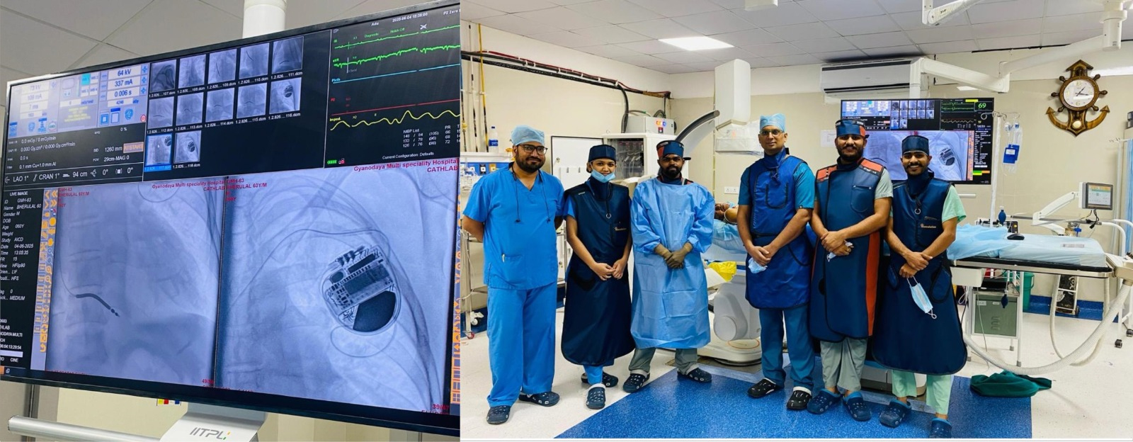 नीमच में पहली बार हुआ  ICD (Implantable Cardioverter Defibrillator) का सफल प्रत्यारोपण, 65 वर्षीय मरीज की जान बचाने में मिली बड़ी सफलता